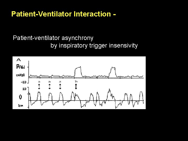 Patient-Ventilator Interaction Patient-ventilator asynchrony by inspiratory trigger insensivity Patient-Ventilator Interaction Patient-ventilator asynchrony by inspiratory trigger insensivity