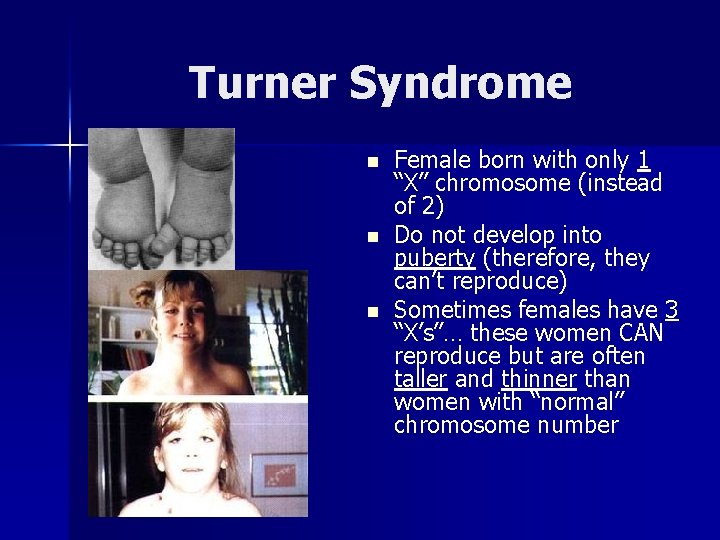 Turner Syndrome n n n Female born with only 1 “X” chromosome (instead of