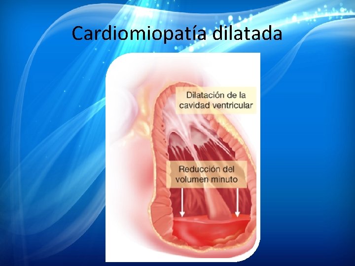 Cardiomiopatía dilatada Cardiomiopatía dilatada