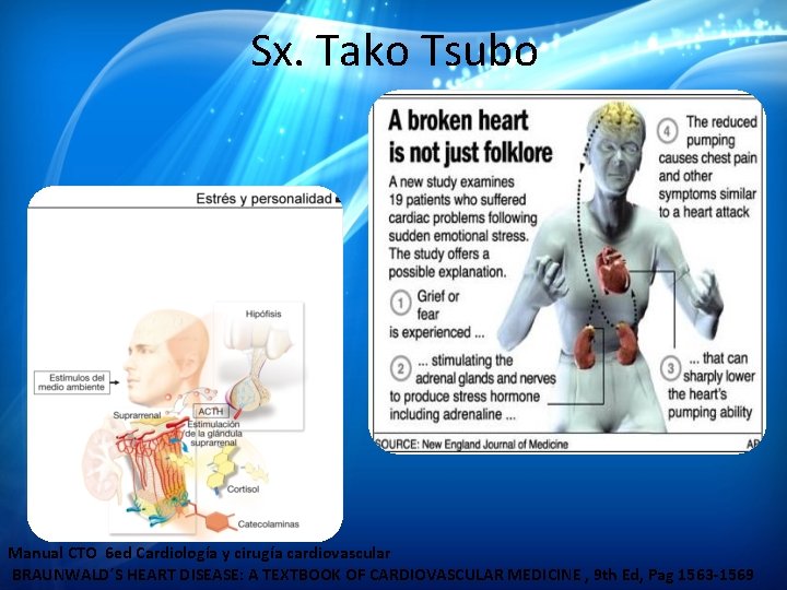 Sx. Tako Tsubo Manual CTO 6 ed Cardiología y cirugía cardiovascular BRAUNWALD´S HEART DISEASE: Sx. Tako Tsubo Manual CTO 6 ed Cardiología y cirugía cardiovascular BRAUNWALD´S HEART DISEASE: