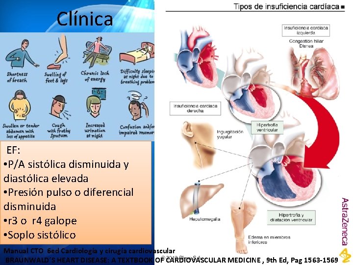 Clínica EF: • P/A sistólica disminuida y diastólica elevada • Presión pulso o diferencial Clínica EF: • P/A sistólica disminuida y diastólica elevada • Presión pulso o diferencial