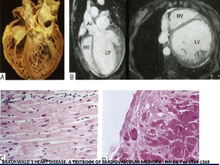 BRAUNWALD´S HEART DISEASE: A TEXTBOOK OF CARDIOVASCULAR MEDICINE , 9 th Ed, Pag 1563 BRAUNWALD´S HEART DISEASE: A TEXTBOOK OF CARDIOVASCULAR MEDICINE , 9 th Ed, Pag 1563