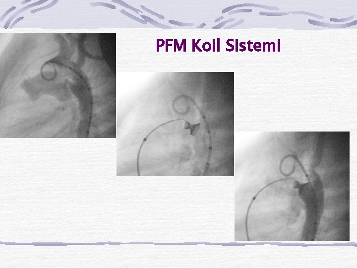 PFM Koil Sistemi 