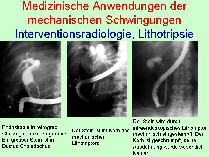 Medizinische Anwendungen der mechanischen Schwingungen Interventionsradiologie, Lithotripsie Der Stein wird durch Endoskopie in retrograd