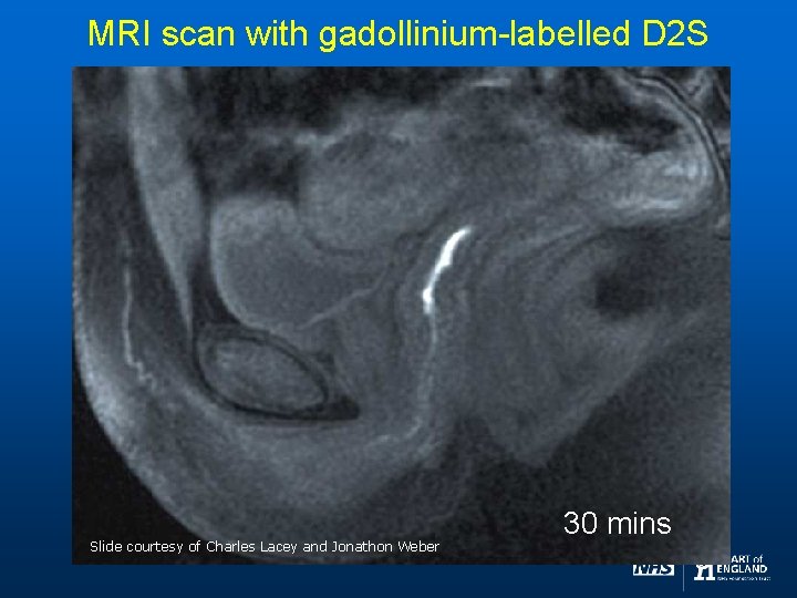 MRI scan with gadollinium-labelled D 2 S Slide courtesy of Charles Lacey and Jonathon