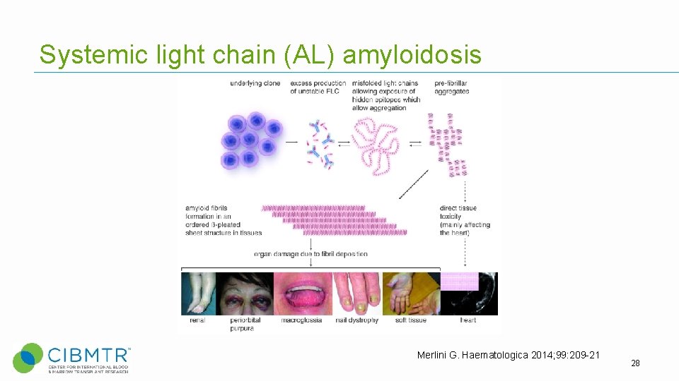 Systemic light chain (AL) amyloidosis Merlini G. Haematologica 2014; 99: 209 -21 28 Systemic light chain (AL) amyloidosis Merlini G. Haematologica 2014; 99: 209 -21 28