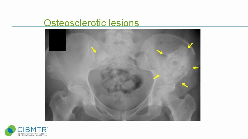 Osteosclerotic lesions Osteosclerotic lesions