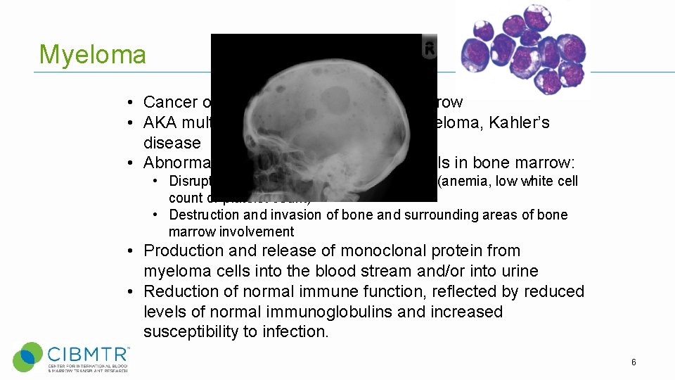 Myeloma • Cancer of plasma cells in the bone marrow • AKA multiple myeloma, Myeloma • Cancer of plasma cells in the bone marrow • AKA multiple myeloma,