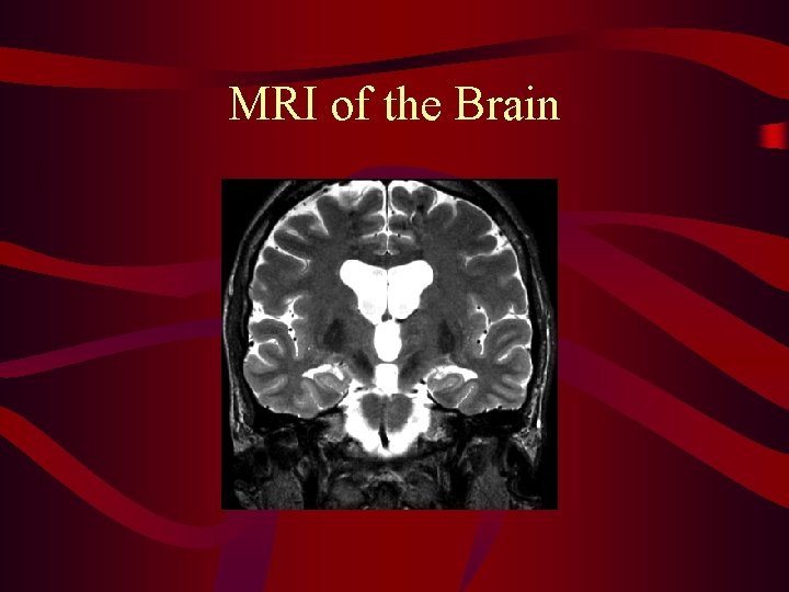 MRI of the Brain 