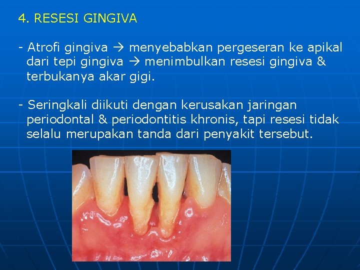 4. RESESI GINGIVA - Atrofi gingiva menyebabkan pergeseran ke apikal dari tepi gingiva menimbulkan