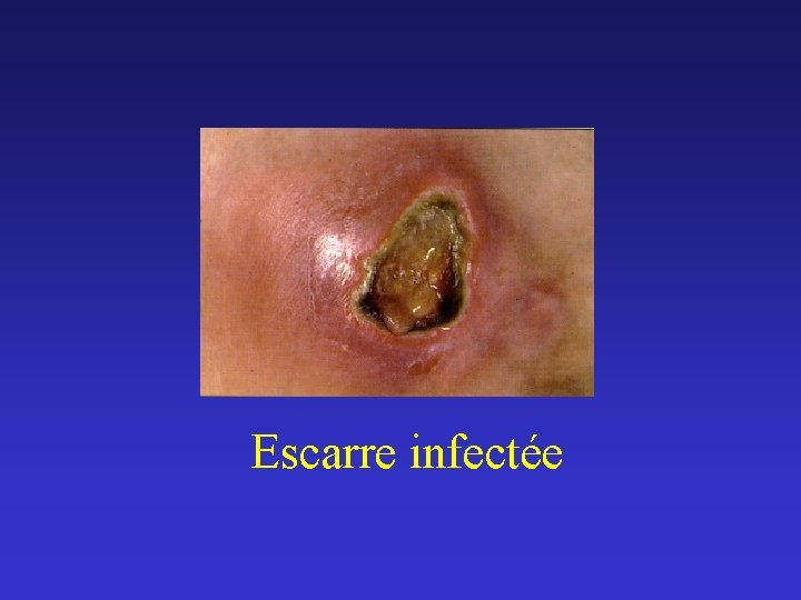 Escarre infectée 