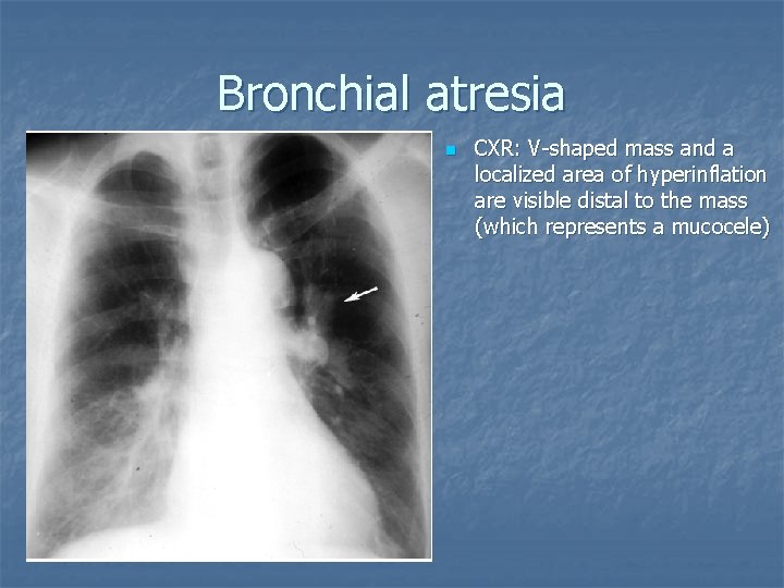 Bronchial atresia n CXR: V-shaped mass and a localized area of hyperinflation are visible