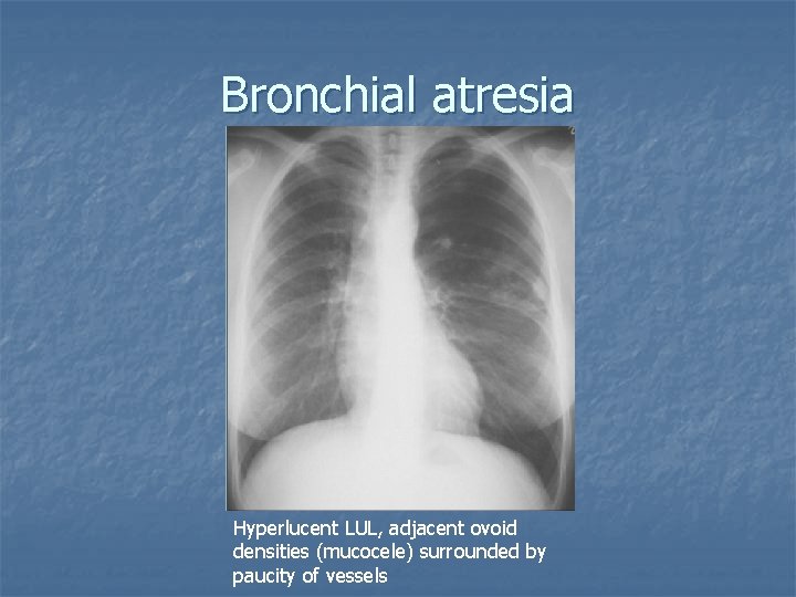 Bronchial atresia Hyperlucent LUL, adjacent ovoid densities (mucocele) surrounded by paucity of vessels 