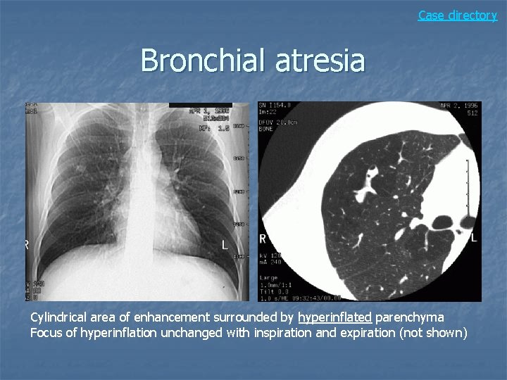 Case directory Bronchial atresia Cylindrical area of enhancement surrounded by hyperinflated parenchyma Focus of