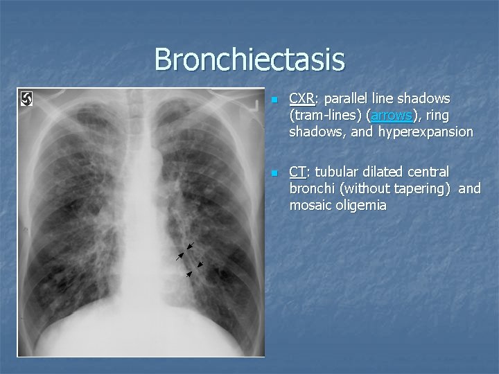 Bronchiectasis n n CXR: parallel line shadows (tram-lines) (arrows), ring shadows, and hyperexpansion CT: