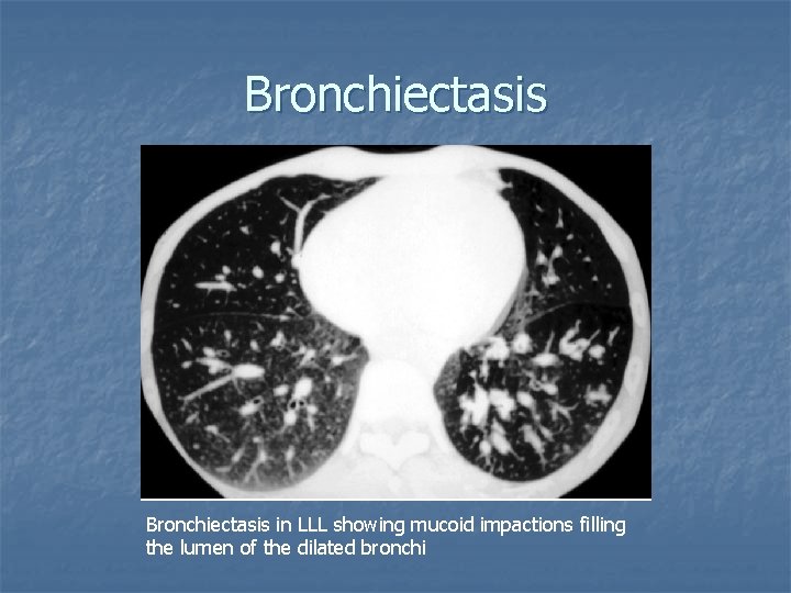 Bronchiectasis in LLL showing mucoid impactions filling the lumen of the dilated bronchi 