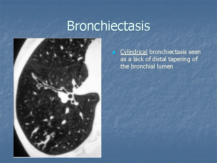 Bronchiectasis n Cylindrical bronchiectasis seen as a lack of distal tapering of the bronchial