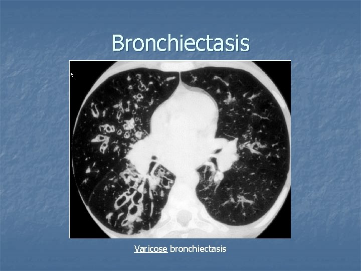 Bronchiectasis Varicose bronchiectasis 