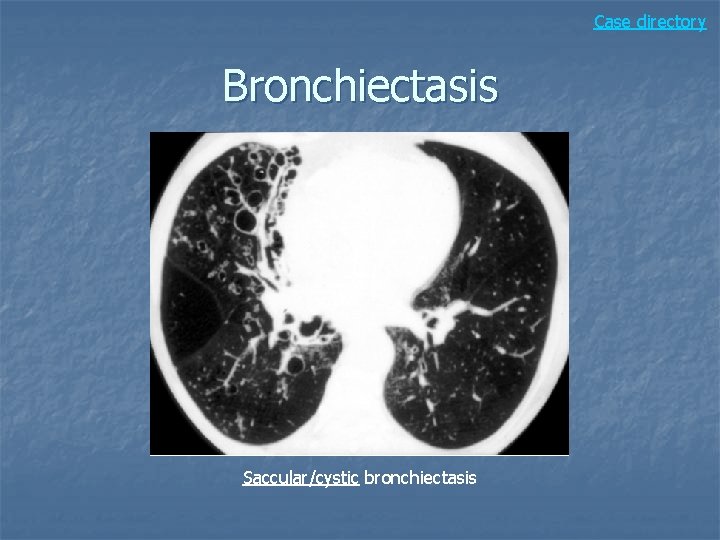 Case directory Bronchiectasis Saccular/cystic bronchiectasis 