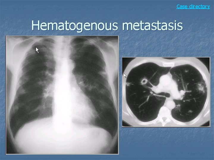 Case directory Hematogenous metastasis 