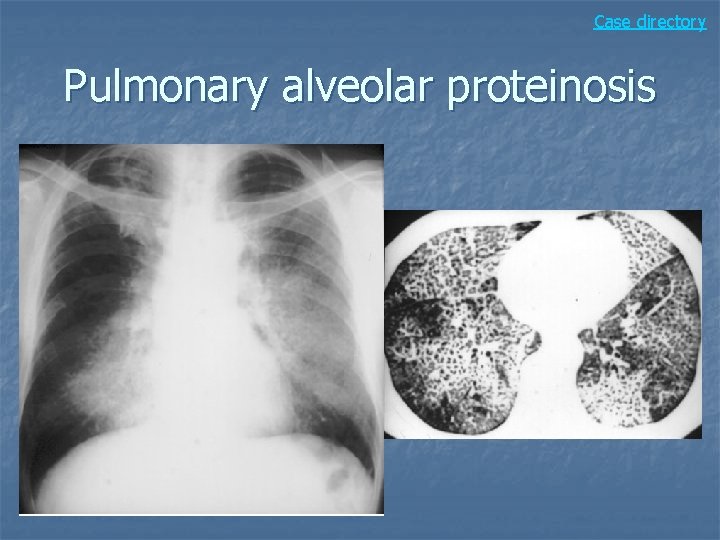 Case directory Pulmonary alveolar proteinosis 