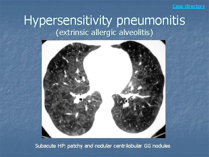 Case directory Hypersensitivity pneumonitis (extrinsic allergic alveolitis) Subacute HP: patchy and nodular centrilobular GG