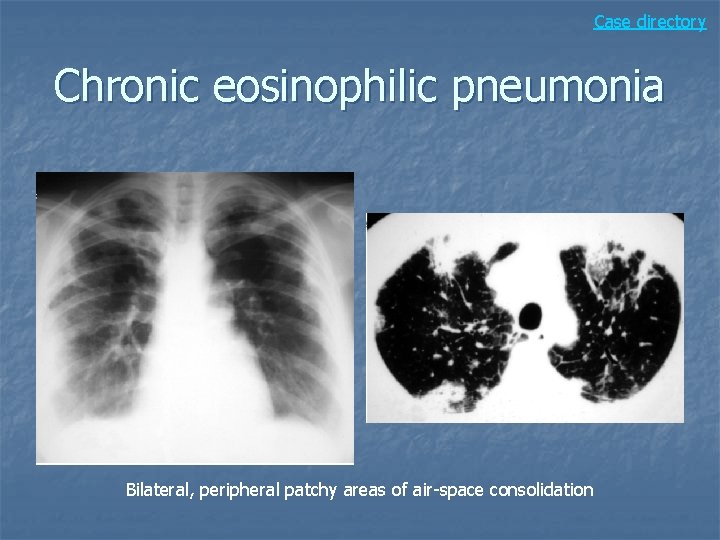 Case directory Chronic eosinophilic pneumonia Bilateral, peripheral patchy areas of air-space consolidation 