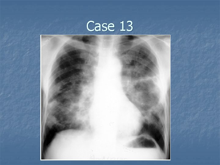 Case 13 