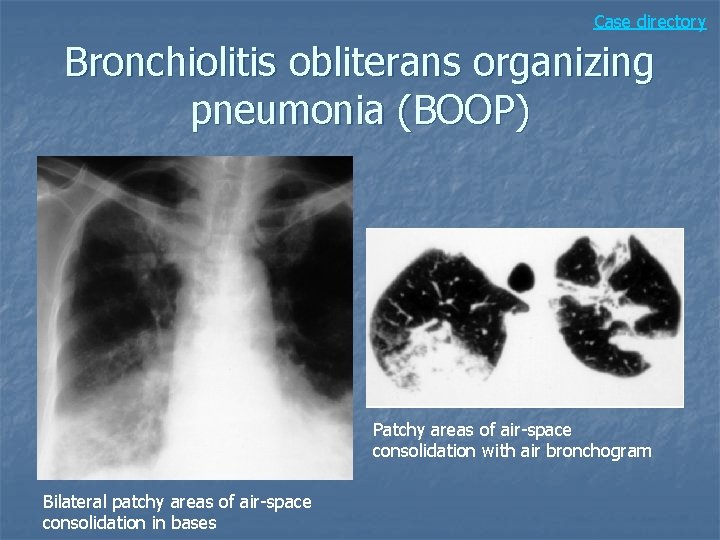Case directory Bronchiolitis obliterans organizing pneumonia (BOOP) Patchy areas of air-space consolidation with air