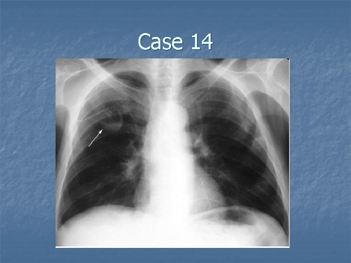 Case 14 