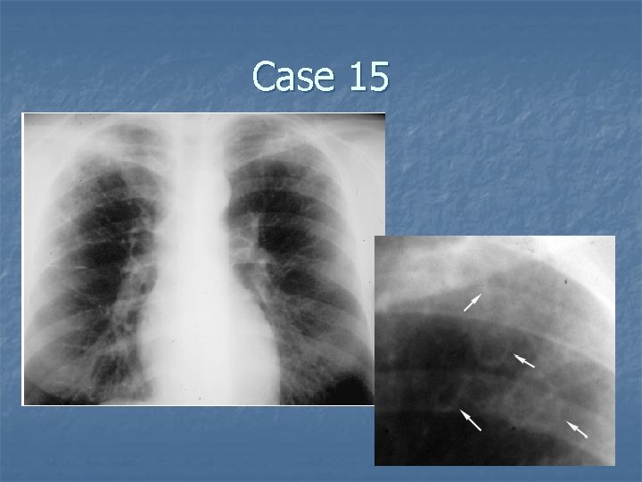 Case 15 
