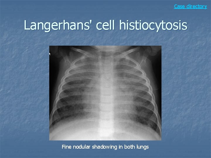 Case directory Langerhans' cell histiocytosis Fine nodular shadowing in both lungs 