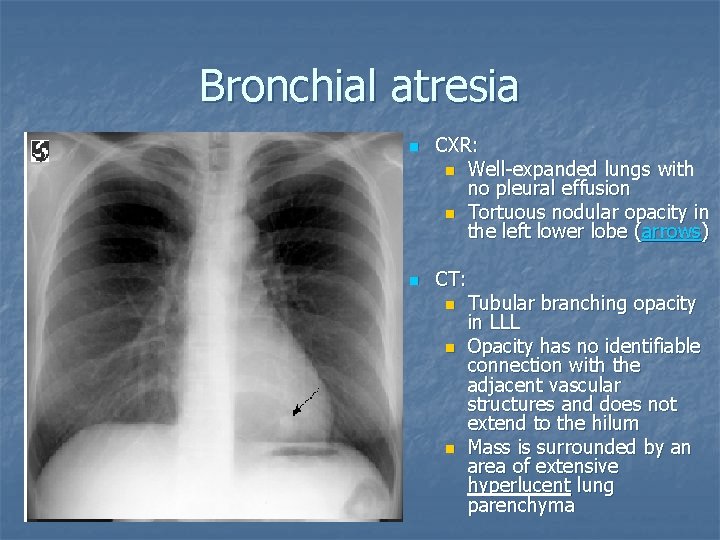 Bronchial atresia n n CXR: n Well-expanded lungs with no pleural effusion n Tortuous