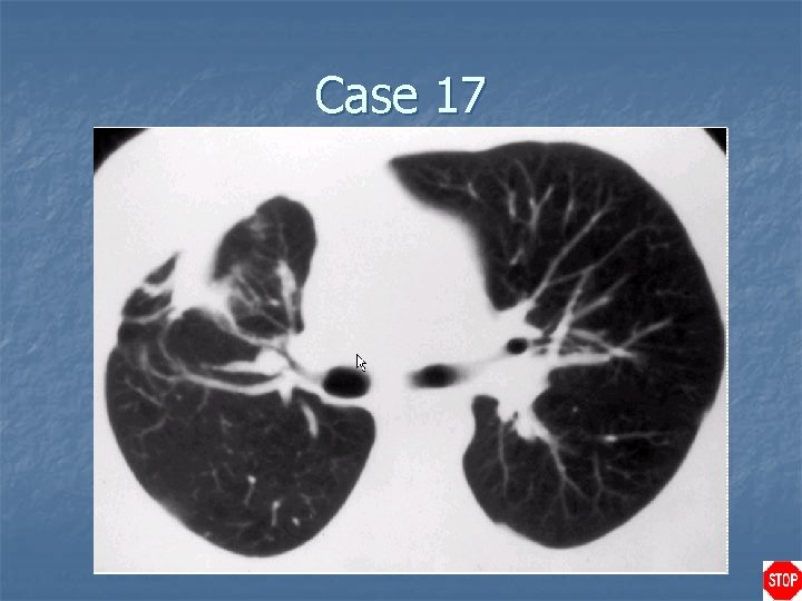 Case 17 