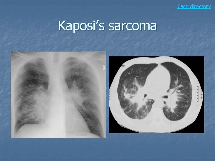 Case directory Kaposi’s sarcoma 
