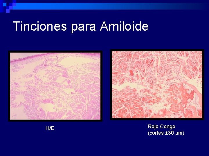 Tinciones para Amiloide H/E Rojo Congo (cortes ± 30 mm) 
