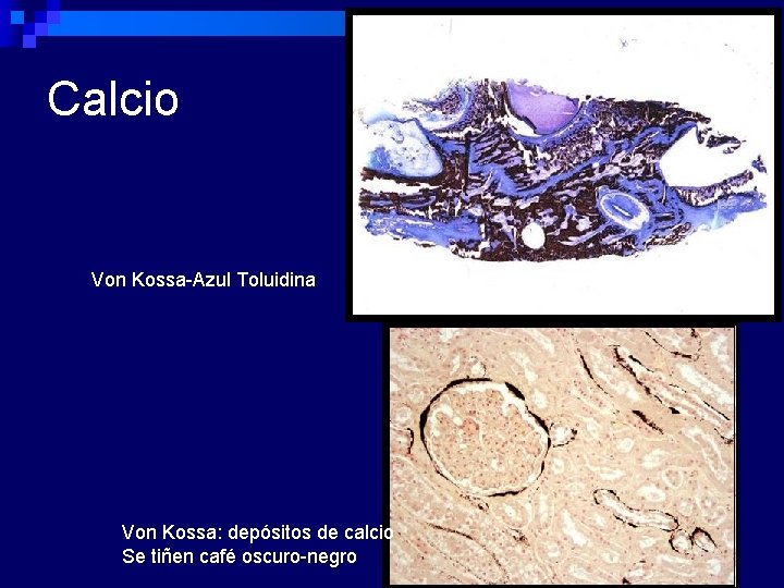 Calcio Von Kossa-Azul Toluidina Von Kossa: depósitos de calcio Se tiñen café oscuro-negro 