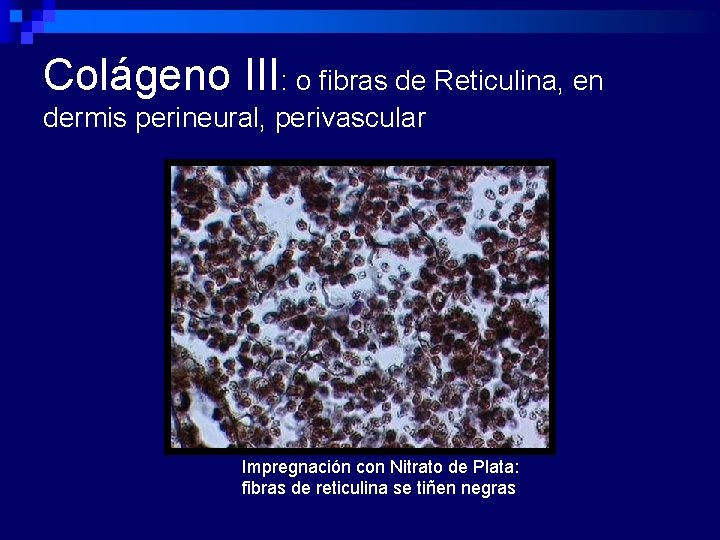 Colágeno III: o fibras de Reticulina, en dermis perineural, perivascular Impregnación con Nitrato de