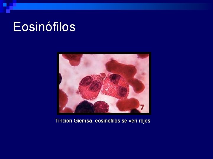 Eosinófilos Tinción Giemsa, eosinófilos se ven rojos 
