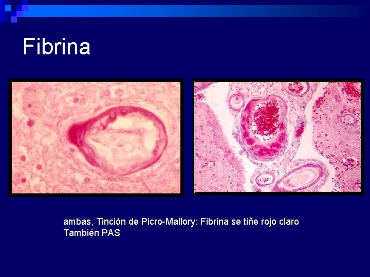Fibrina ambas, Tinción de Picro-Mallory: Fibrina se tiñe rojo claro También PAS 