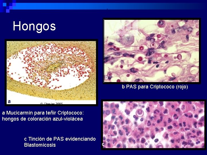 b Hongos b b PAS para Criptococo (rojo) a a Mucicarmin para teñir Criptococo: