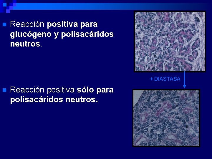n Reacción positiva para glucógeno y polisacáridos neutros. + DIASTASA n Reacción positiva sólo