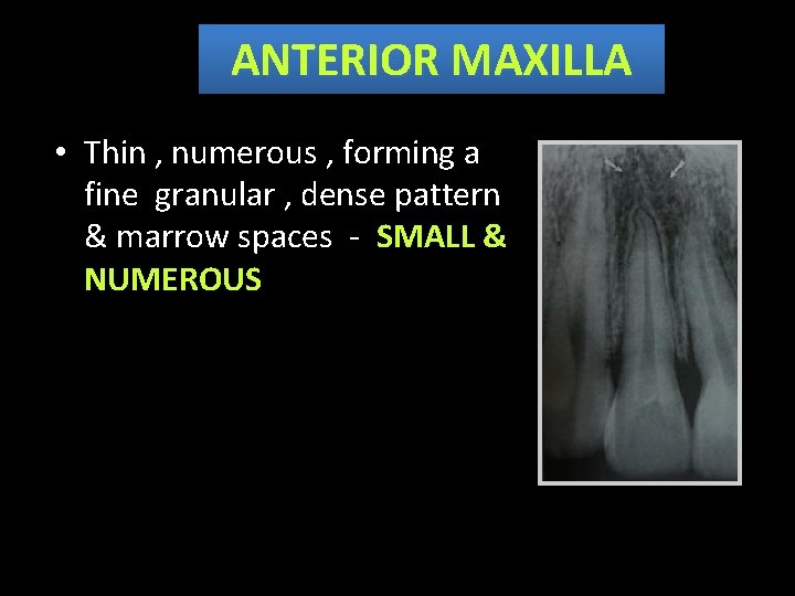 ANTERIOR MAXILLA • Thin , numerous , forming a fine granular , dense pattern