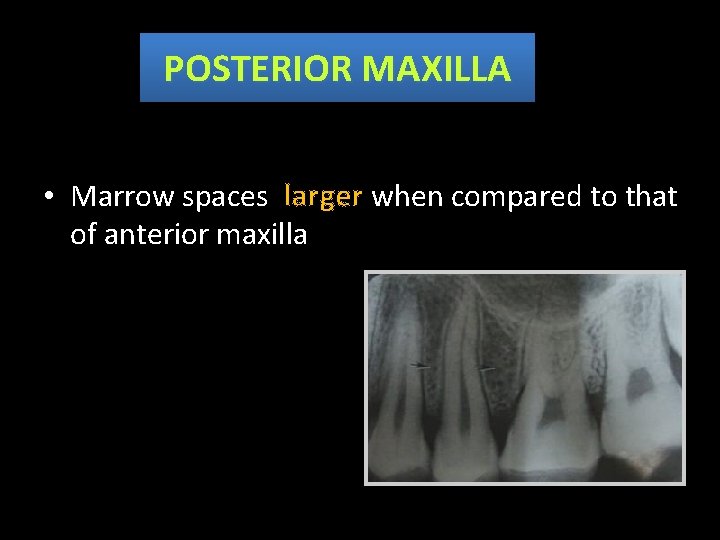 POSTERIOR MAXILLA • Marrow spaces larger when compared to that of anterior maxilla 