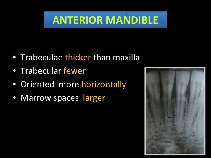 ANTERIOR MANDIBLE • • Trabeculae thicker than maxilla Trabecular fewer Oriented more horizontally Marrow