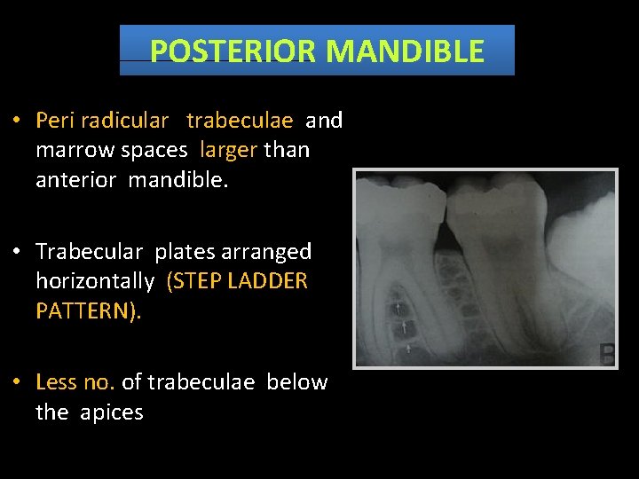 POSTERIOR MANDIBLE • Peri radicular trabeculae and marrow spaces larger than anterior mandible. •