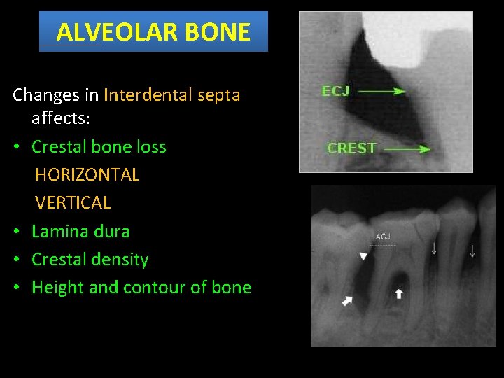 ALVEOLAR BONE Changes in Interdental septa affects: • Crestal bone loss HORIZONTAL VERTICAL •