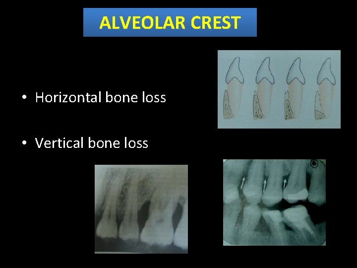 ALVEOLAR CREST • Horizontal bone loss • Vertical bone loss 