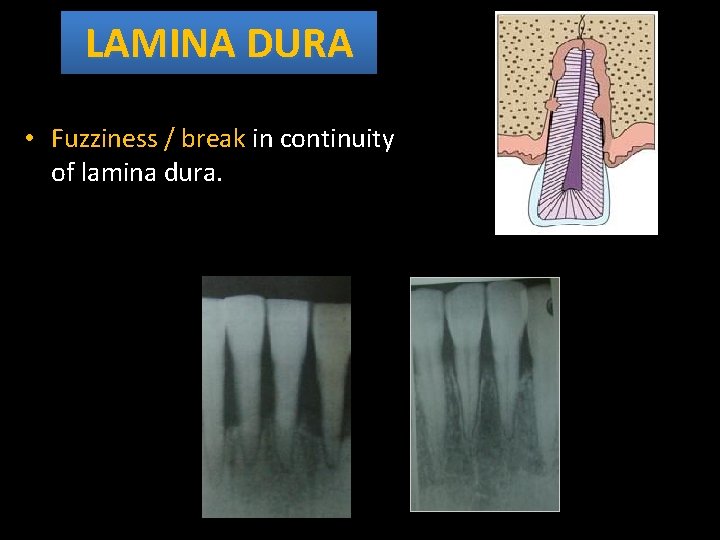 LAMINA DURA • Fuzziness / break in continuity of lamina dura. 