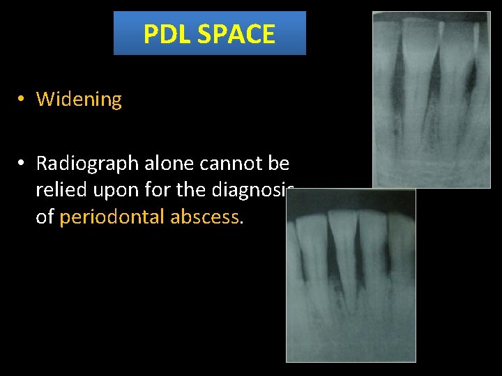 PDL SPACE • Widening • Radiograph alone cannot be relied upon for the diagnosis